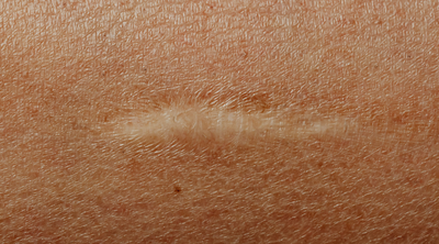 Recuperação Pós-Operatória: Como as Compressas ADA Ajudam na Cicatrização Segura