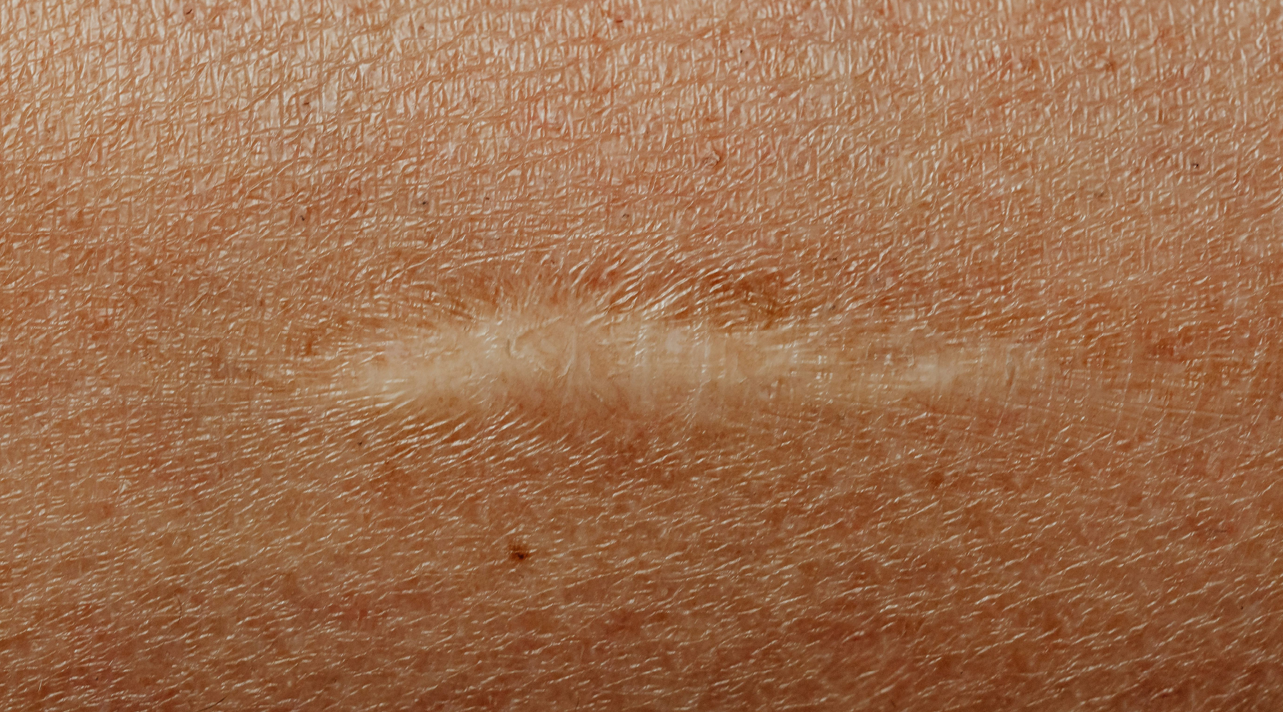 Recuperação Pós-Operatória: Como as Compressas ADA Ajudam na Cicatrização Segura